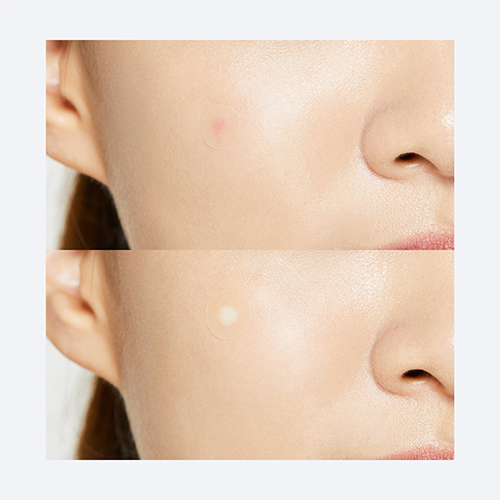 COSRX-Acne Pimple Master 24 patches