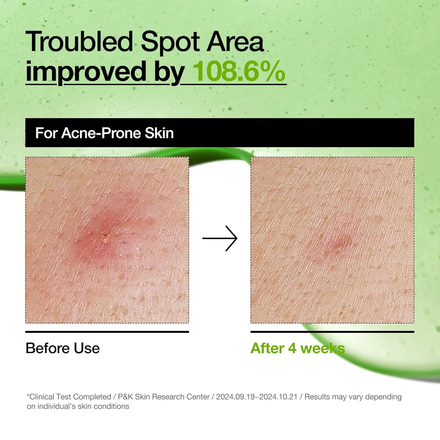 ANUA -Azelaic Acid 10 Hyaluron Redness Soothing Serum 30ml